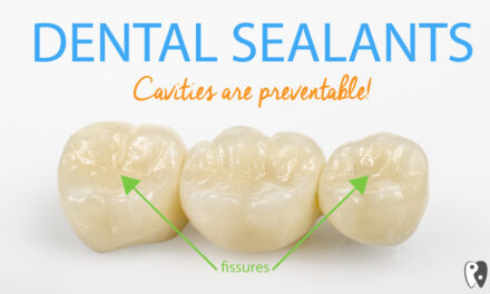 Dental Sealants – To Seal Or Not To Seal?