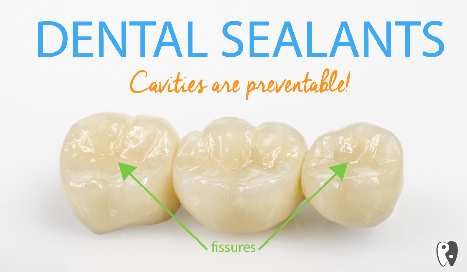 Dental Sealants can prevent cavities in children and adults.