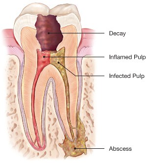 Picture of an infected tooth and pulp with abscess that needs a root canal therapy