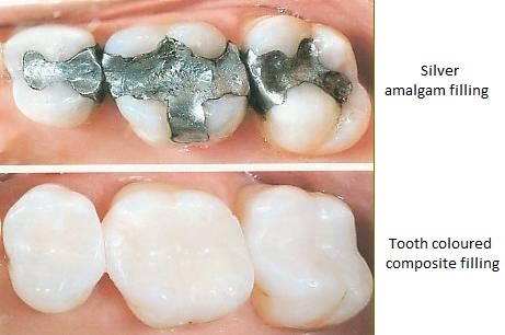 Tooth Colored Composite Fillings vs. Silver Mercury Amalgam Fillings