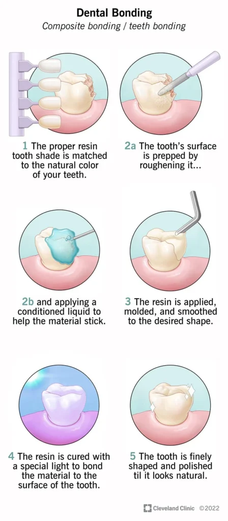 Cosmetic Dental Bonding