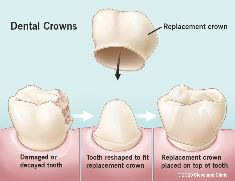 Dental Crowns