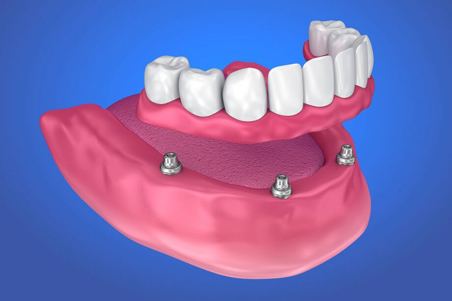 Implant dentures